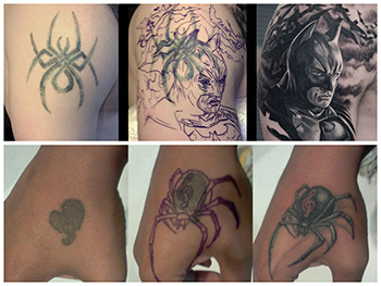 Encubrimiento de tatuajes