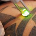 Tattoo Removal: information and advice